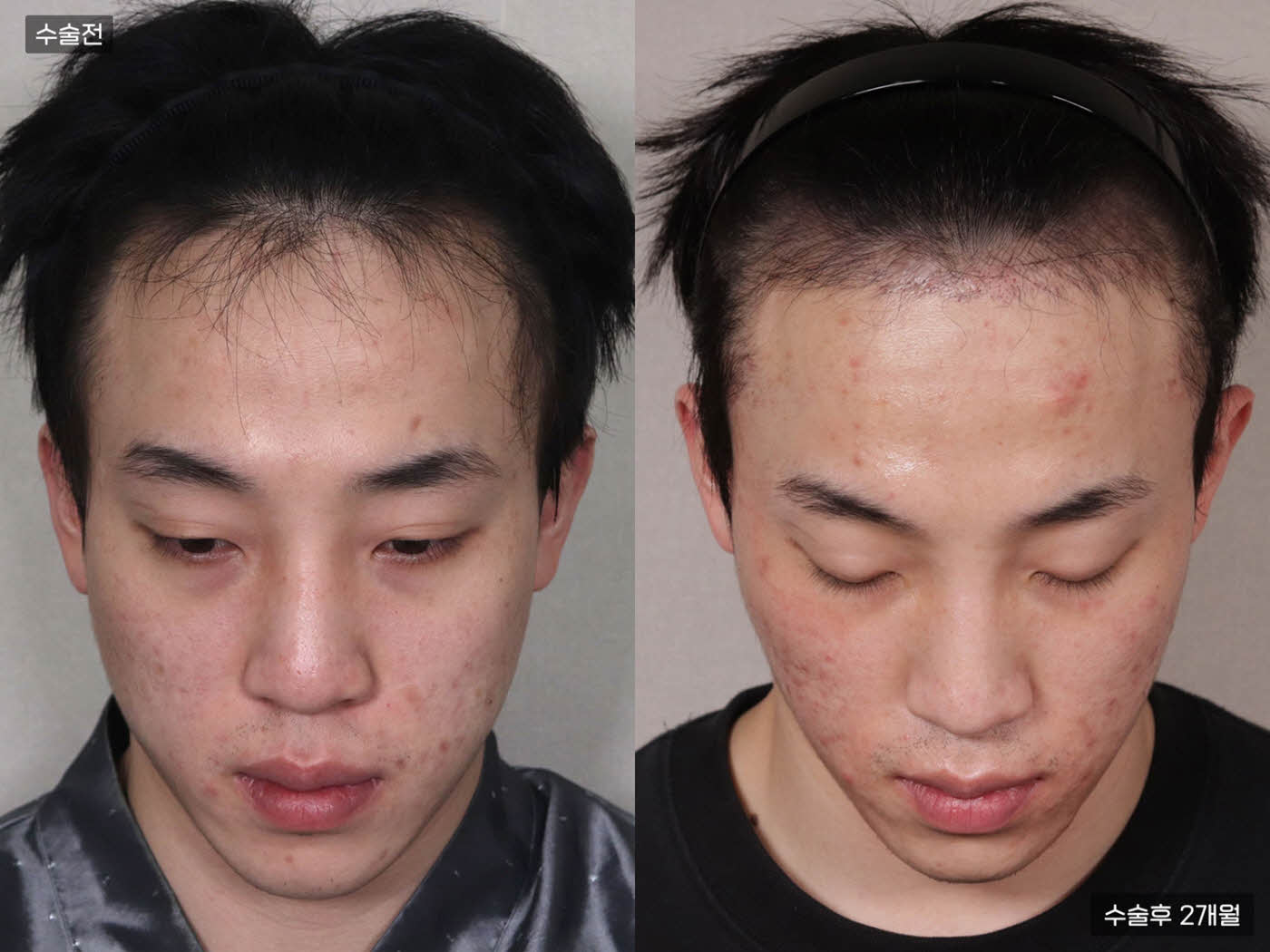 모발이식[절개 모발이식(3000모)]