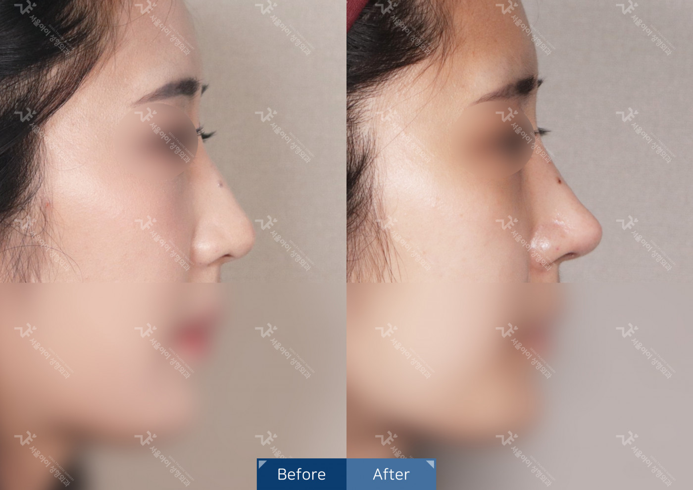 코성형[코끝조각술+비중격+복코교정술]