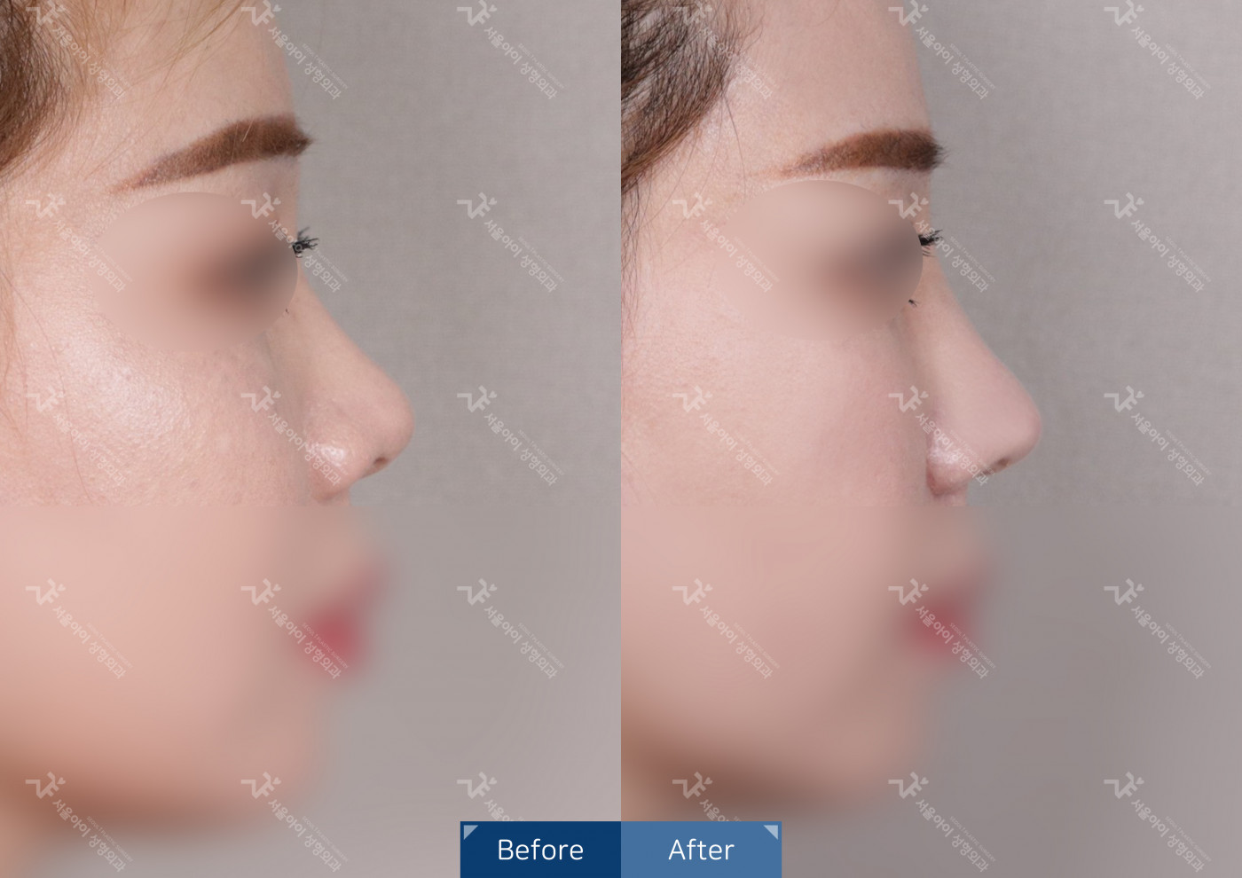 코성형 [코끝조각술+비중격+복코+메부리코]