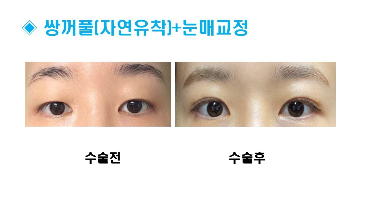 눈성형 [쌍꺼풀 + 눈매교정]