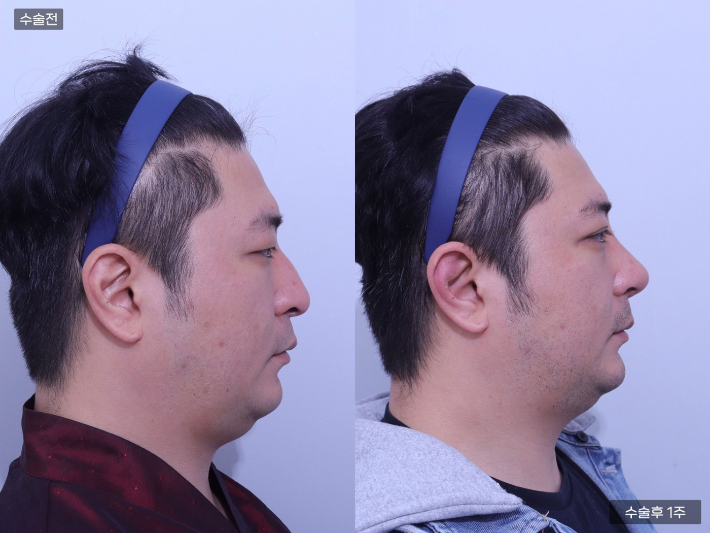 코끝 + 복코교정 + 매부리코 + 휜코