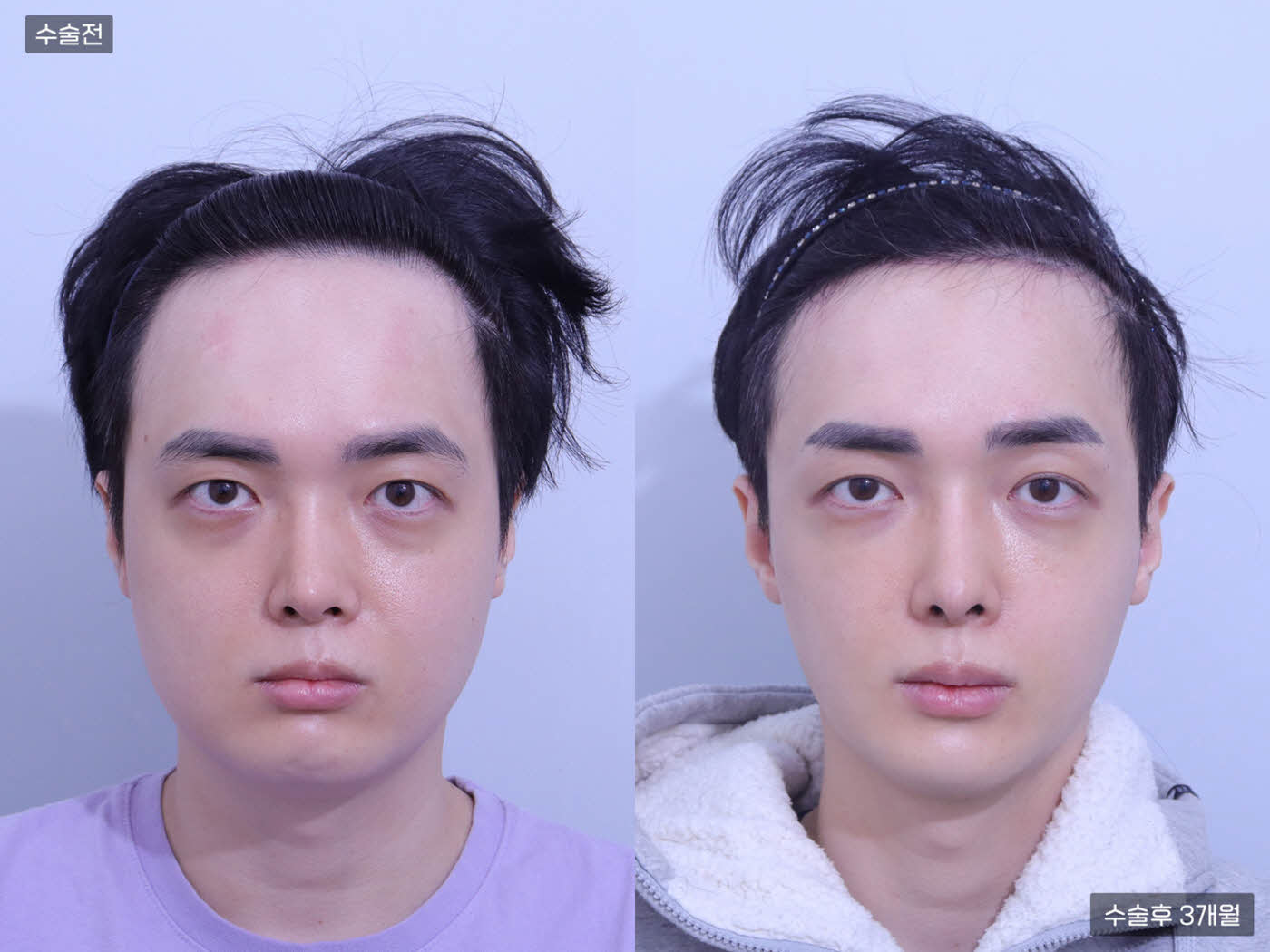 광대뼈 + 사각턱 + 턱끝 + 이마축소