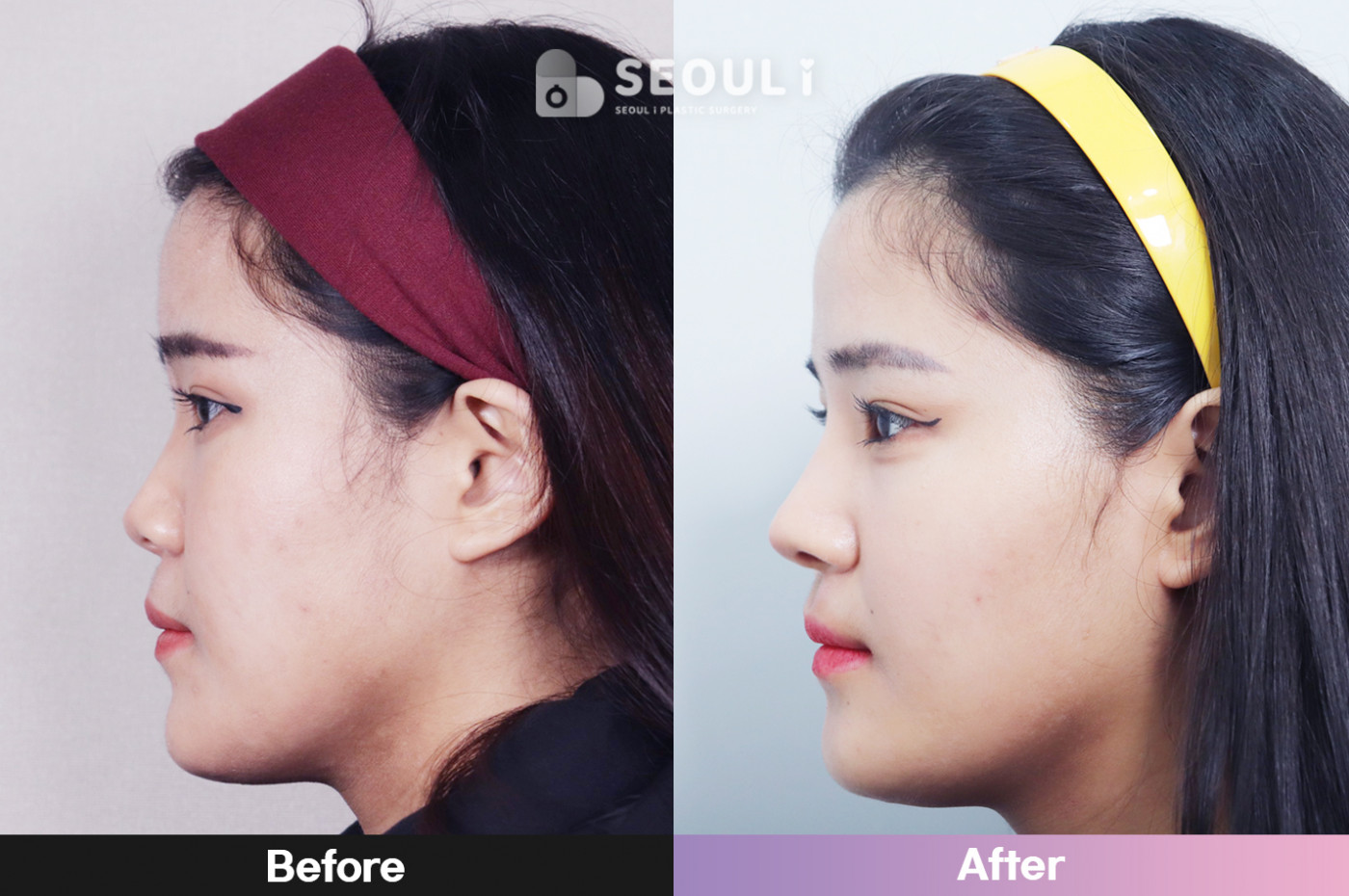 코끝(비중격) + 콧볼 축소술 + 짧은코 교정