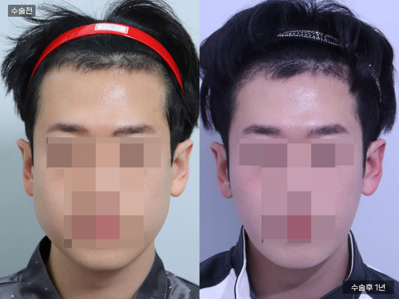 모발이식[비절개 모발이식(2700모)]