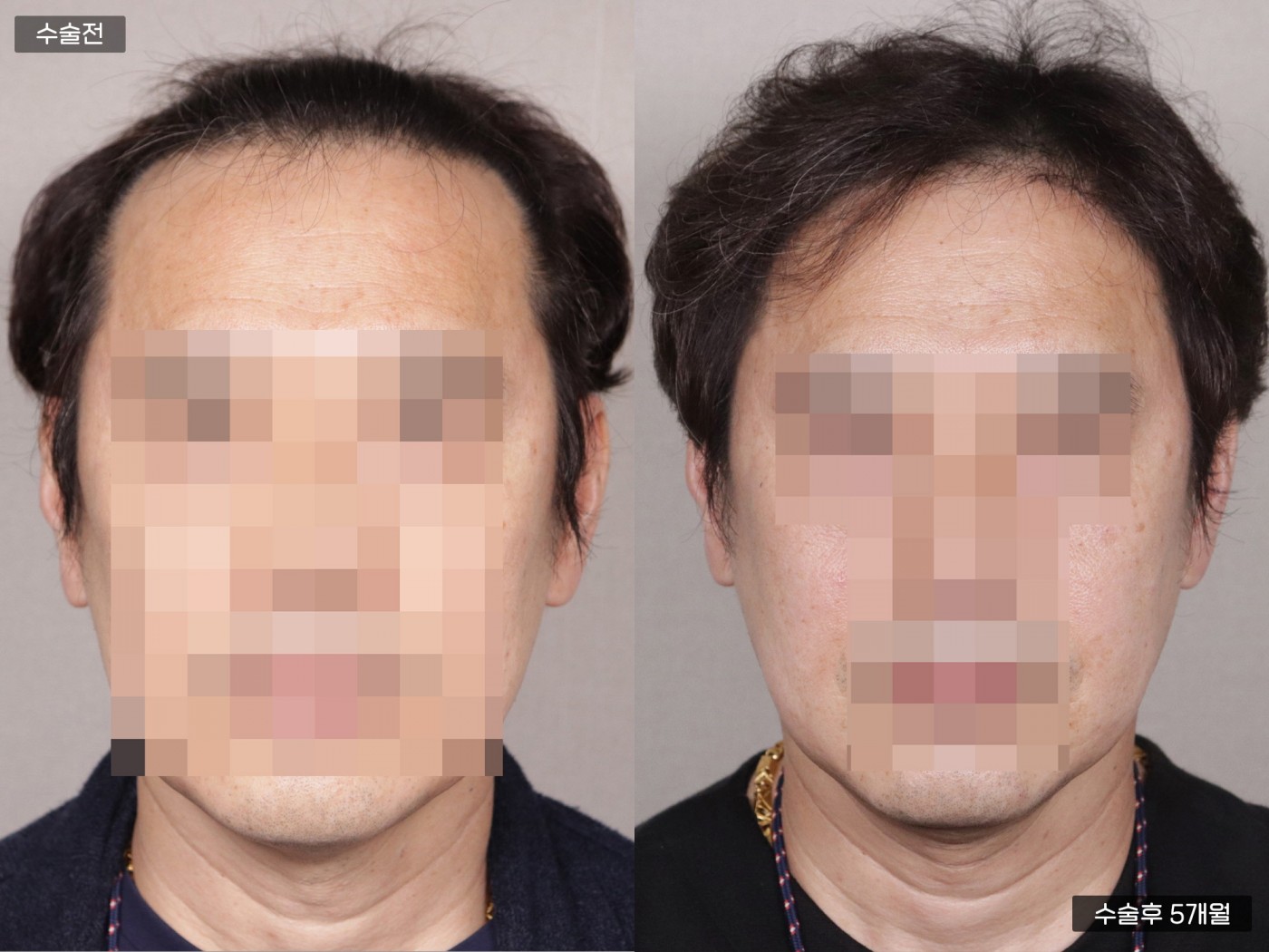 모발이식 [비절개 모발이식(3000모)]