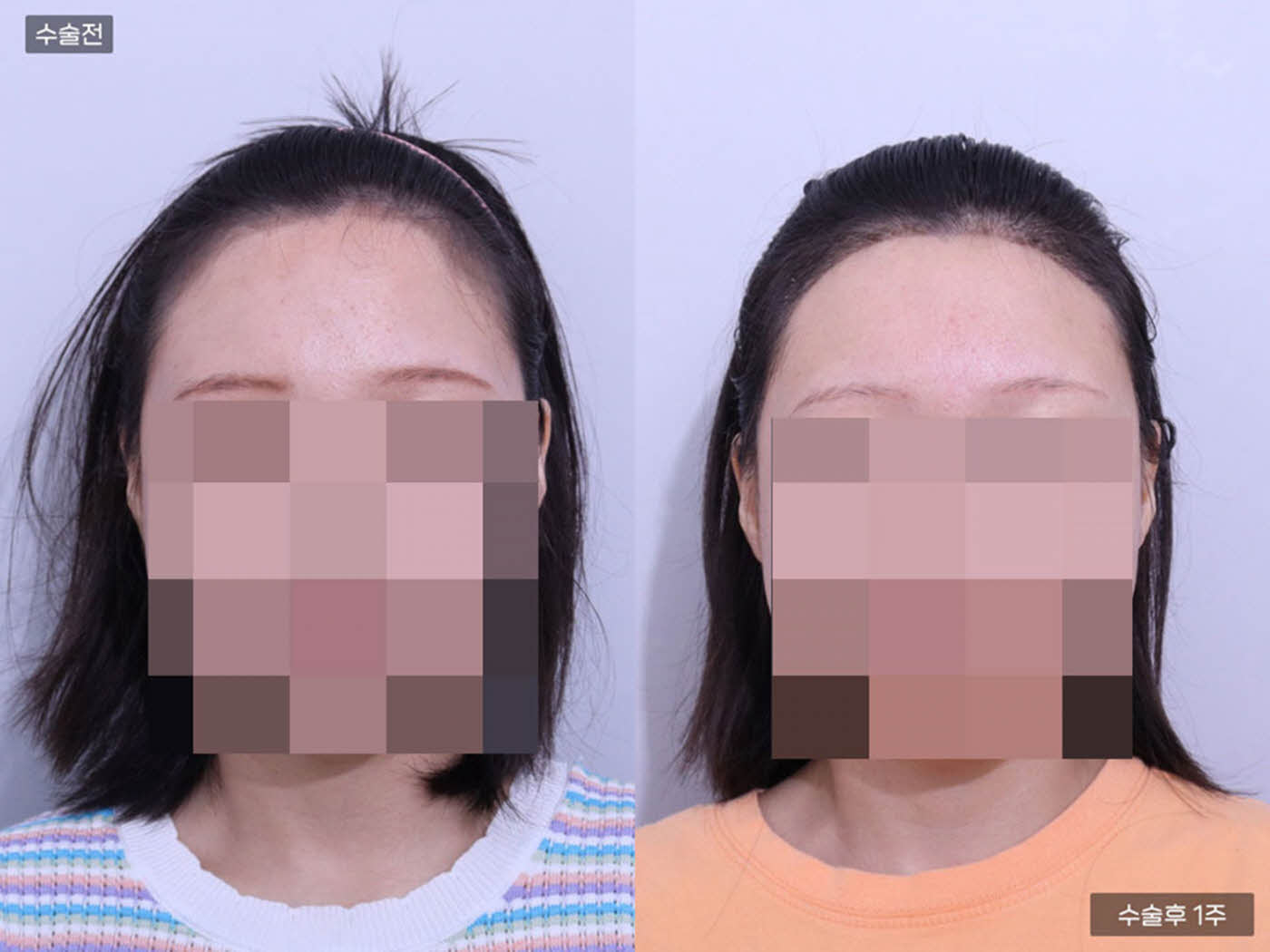 모발이식[절개 모발이식(1500모)]