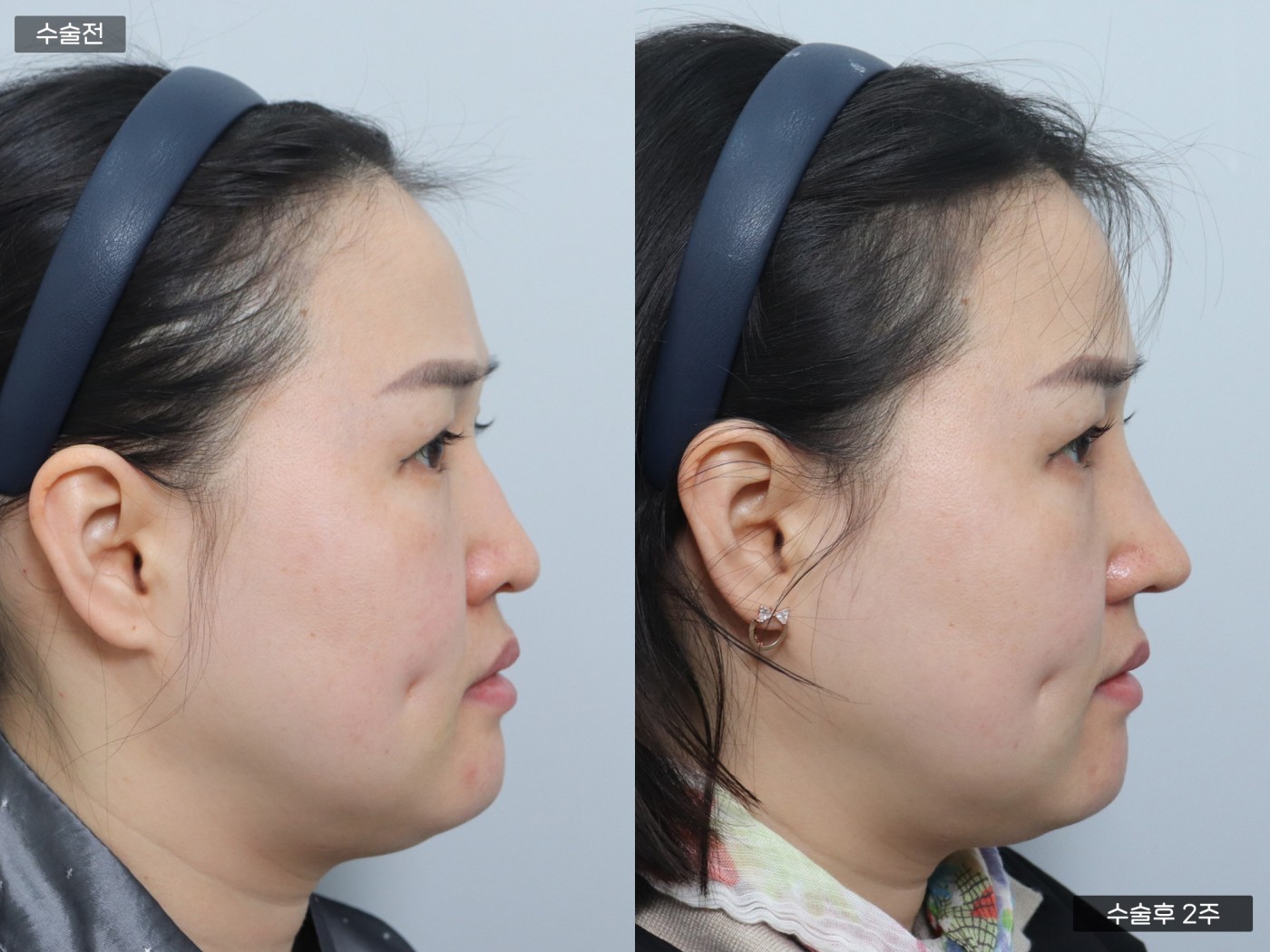 낮은코 + 복코 + 매부리코 + 콧볼축소