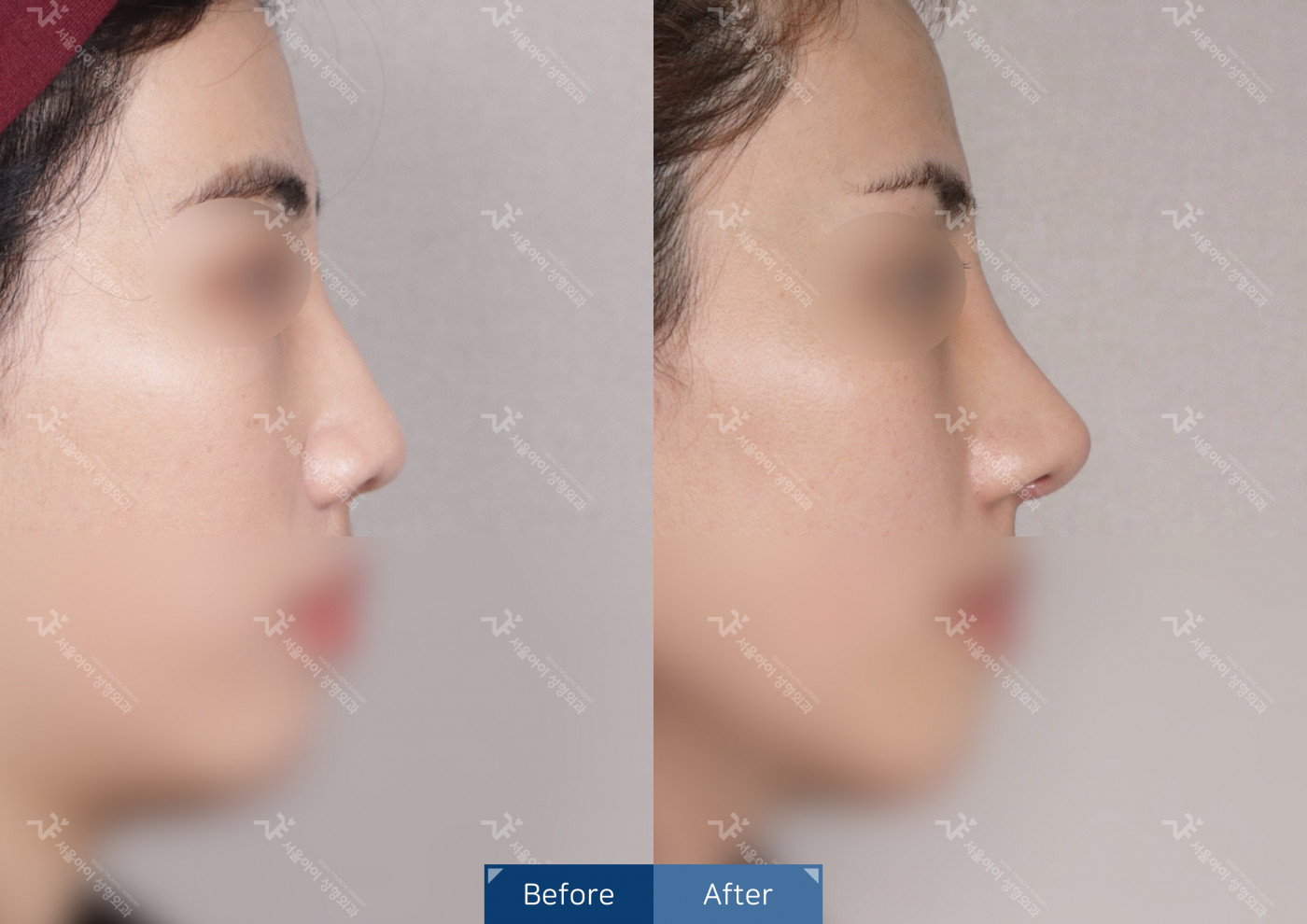 코성형[코끝조각술+복코교정술+메부리]