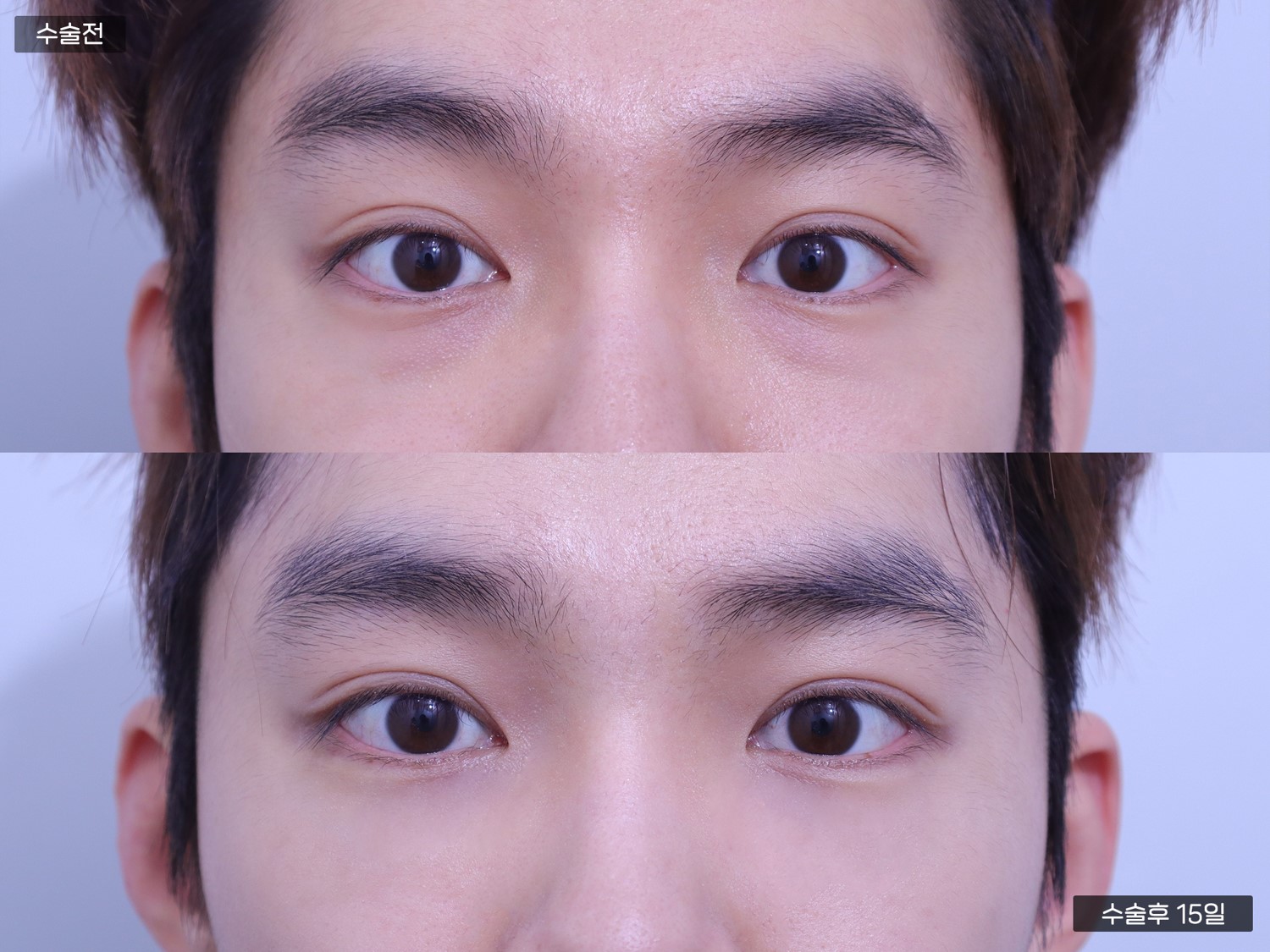 눈밑지방재배치