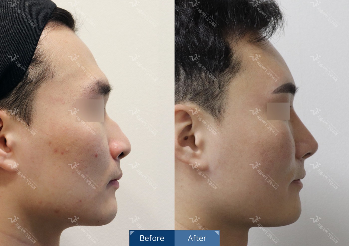 코성형 [융비술&코끝조각술+콧볼축소술+휜코교정술+메부리코교정]