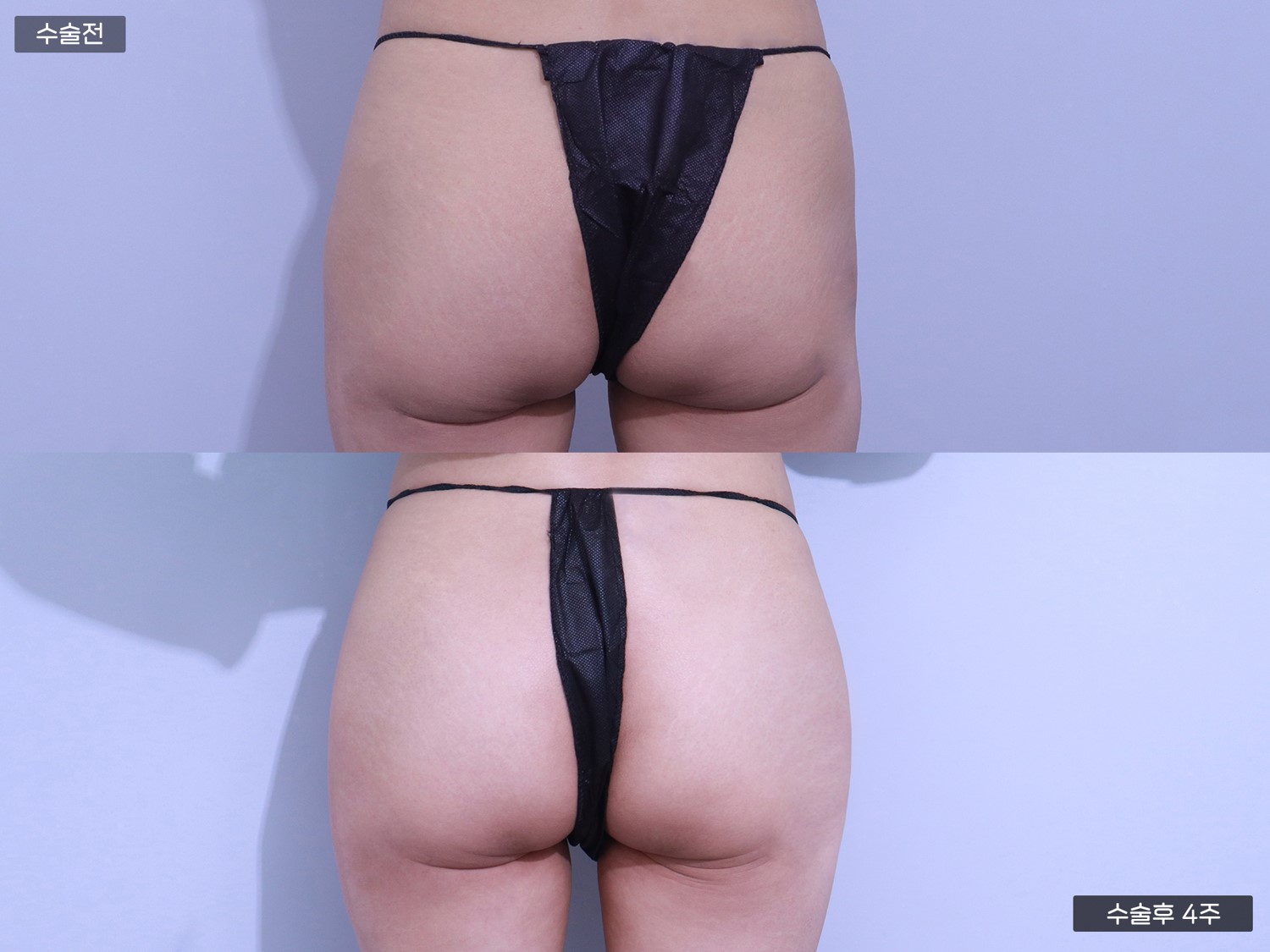 PRP 엉덩이 지방이식 (100cc + 100cc)