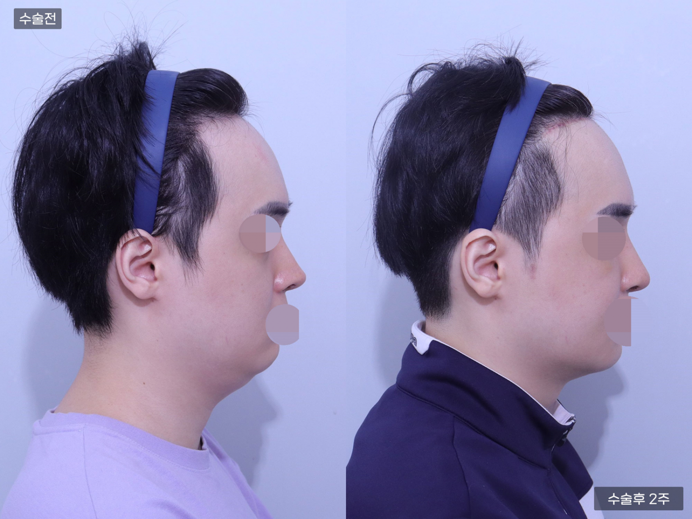 코재수술 + 코끝