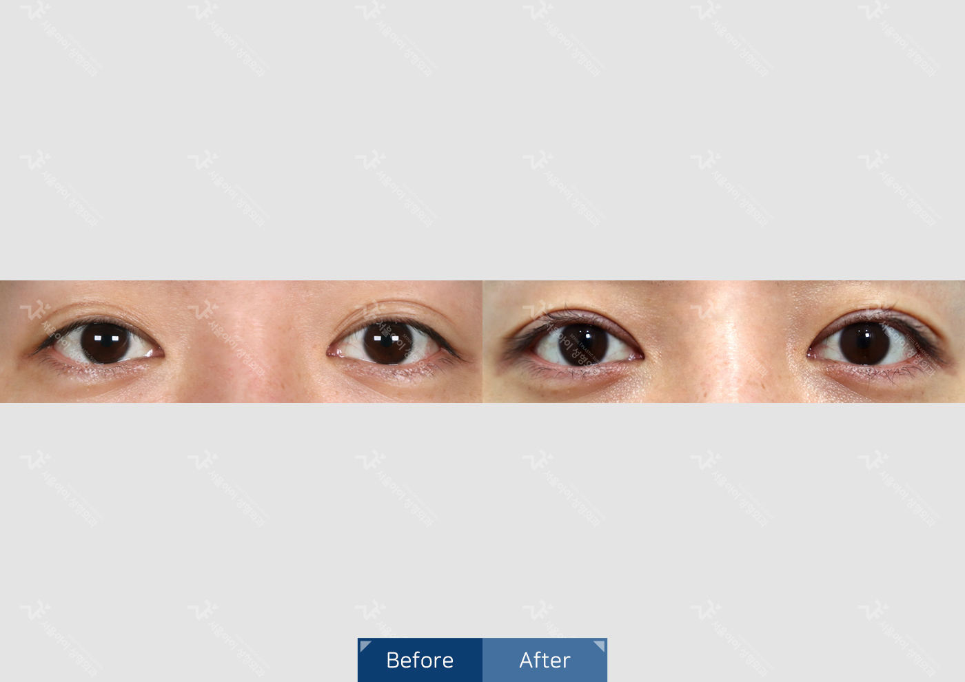 눈성형 [자연유착 쌍꺼풀 + 눈매교정]