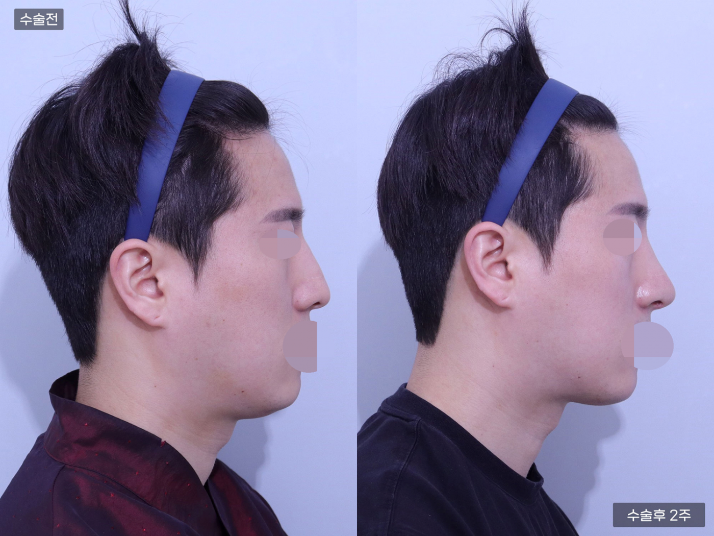 코끝 + 복코 + 매부리코 + 콧볼축소