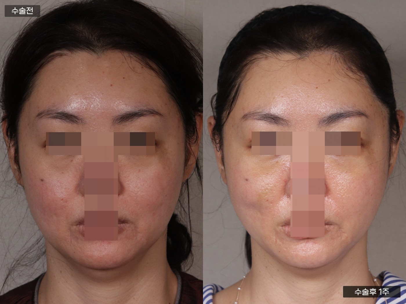 리프팅 [관자거상]