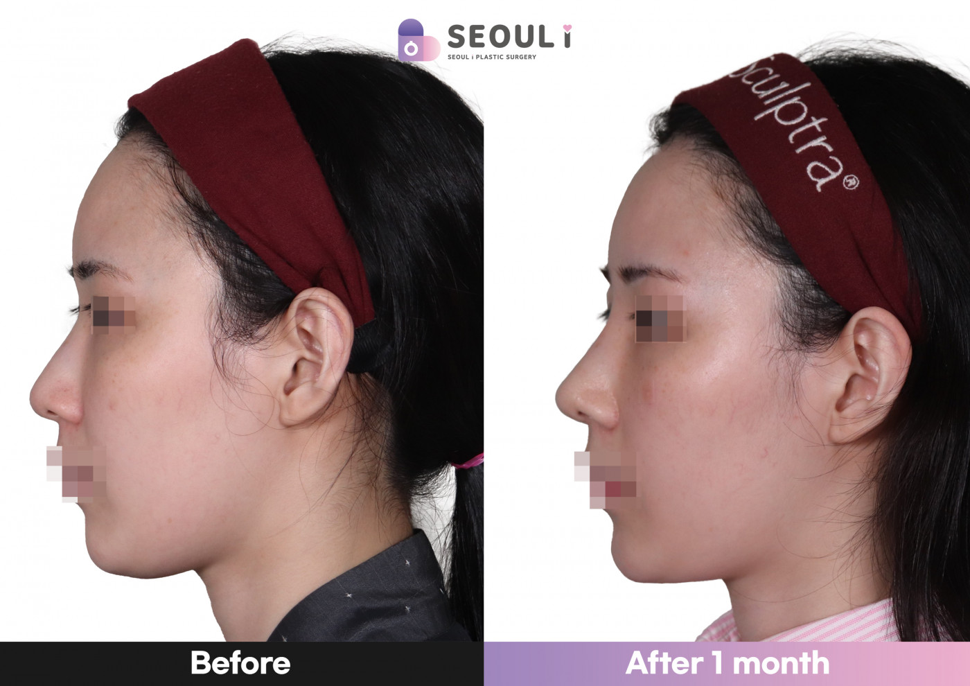 코끝(비중격) + 콧대