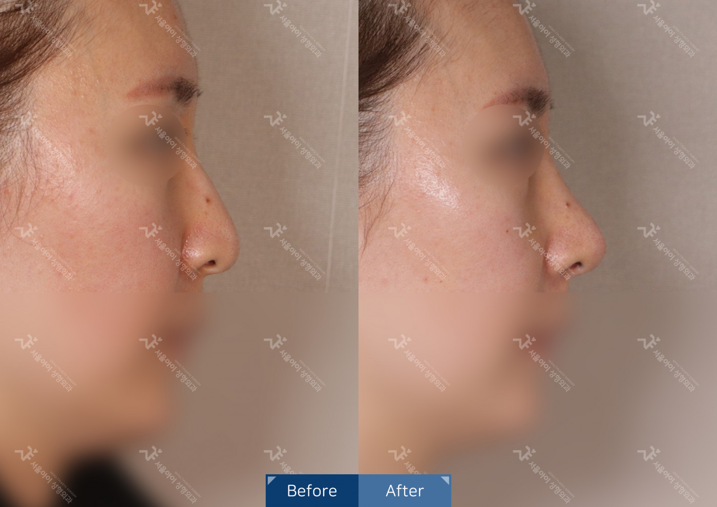 코성형[코끝조각술+비중격+복코교정술]