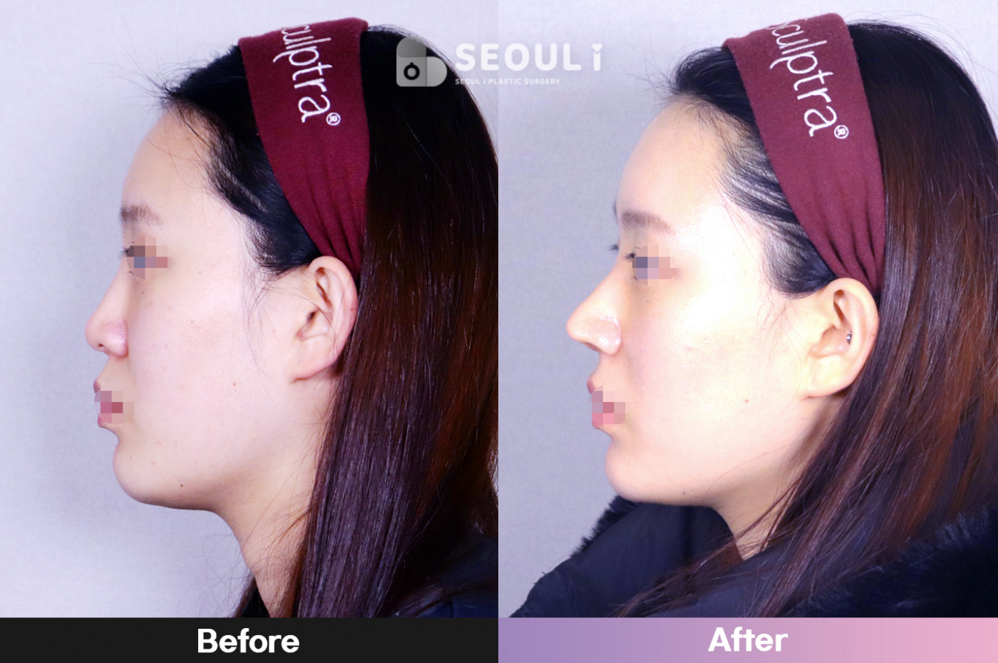 코끝(비중격) + 콧볼 축소술 + 매부리 교정