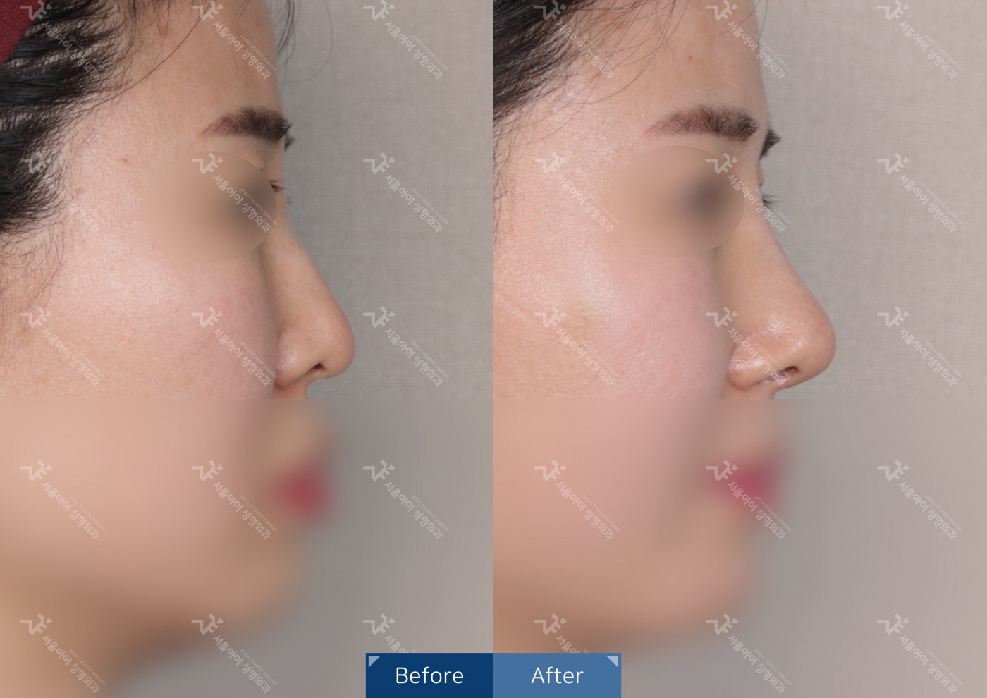 코성형 [융비술&코끝조각술(비중격)+복코교정술+메부리코]