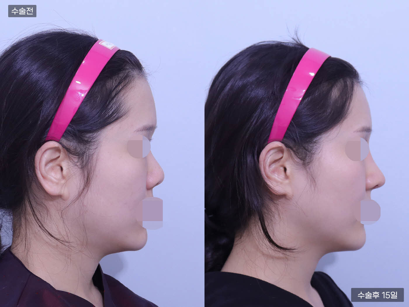 코재수술 + 코끝교정