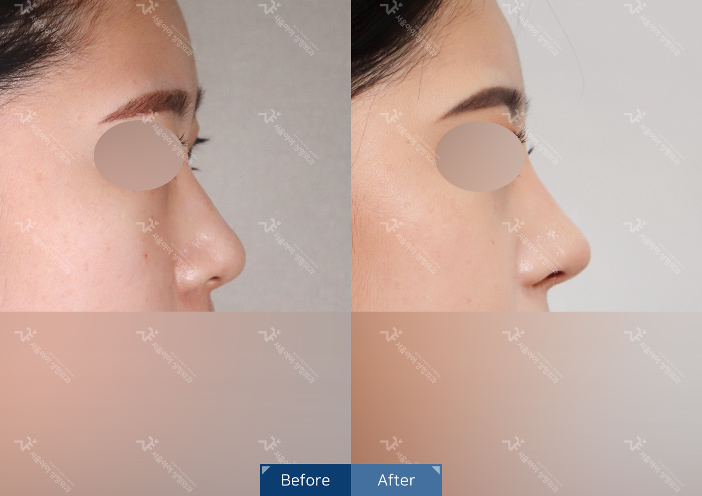 코성형[기능2종 + 미용코]