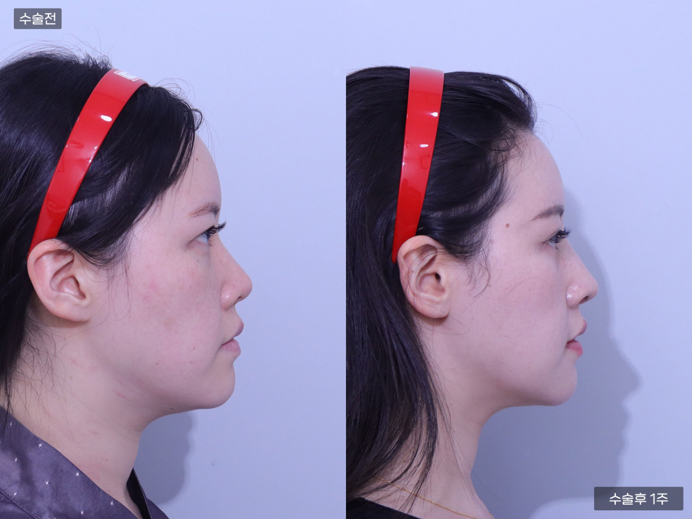 복코 + 매부리코 + 코끝(비중격)