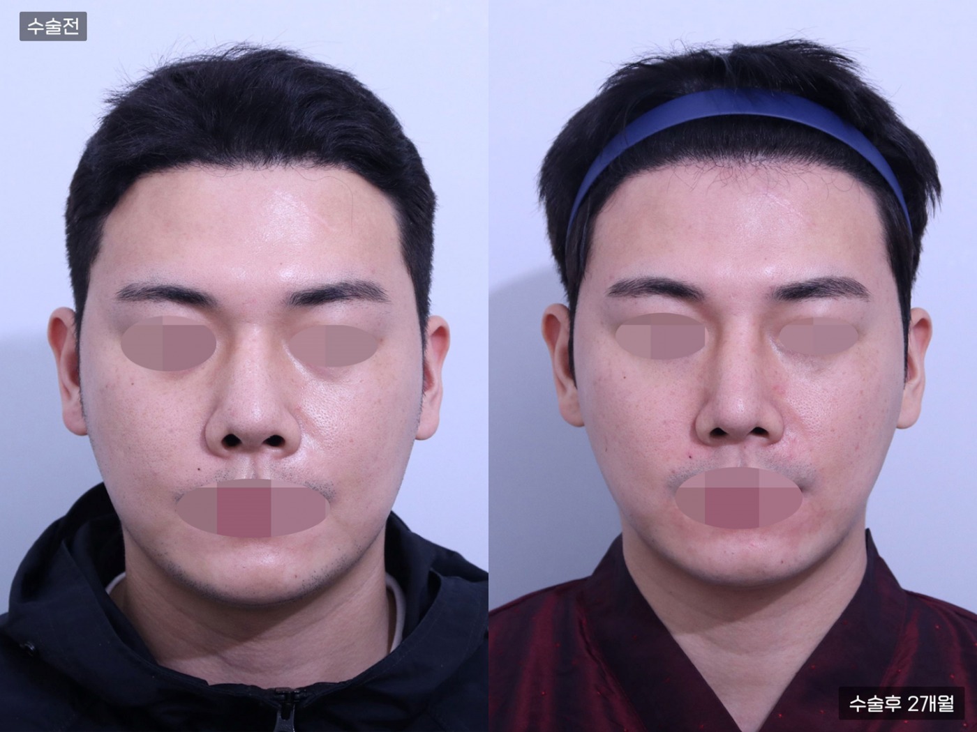 지방흡입 [풀페이스]