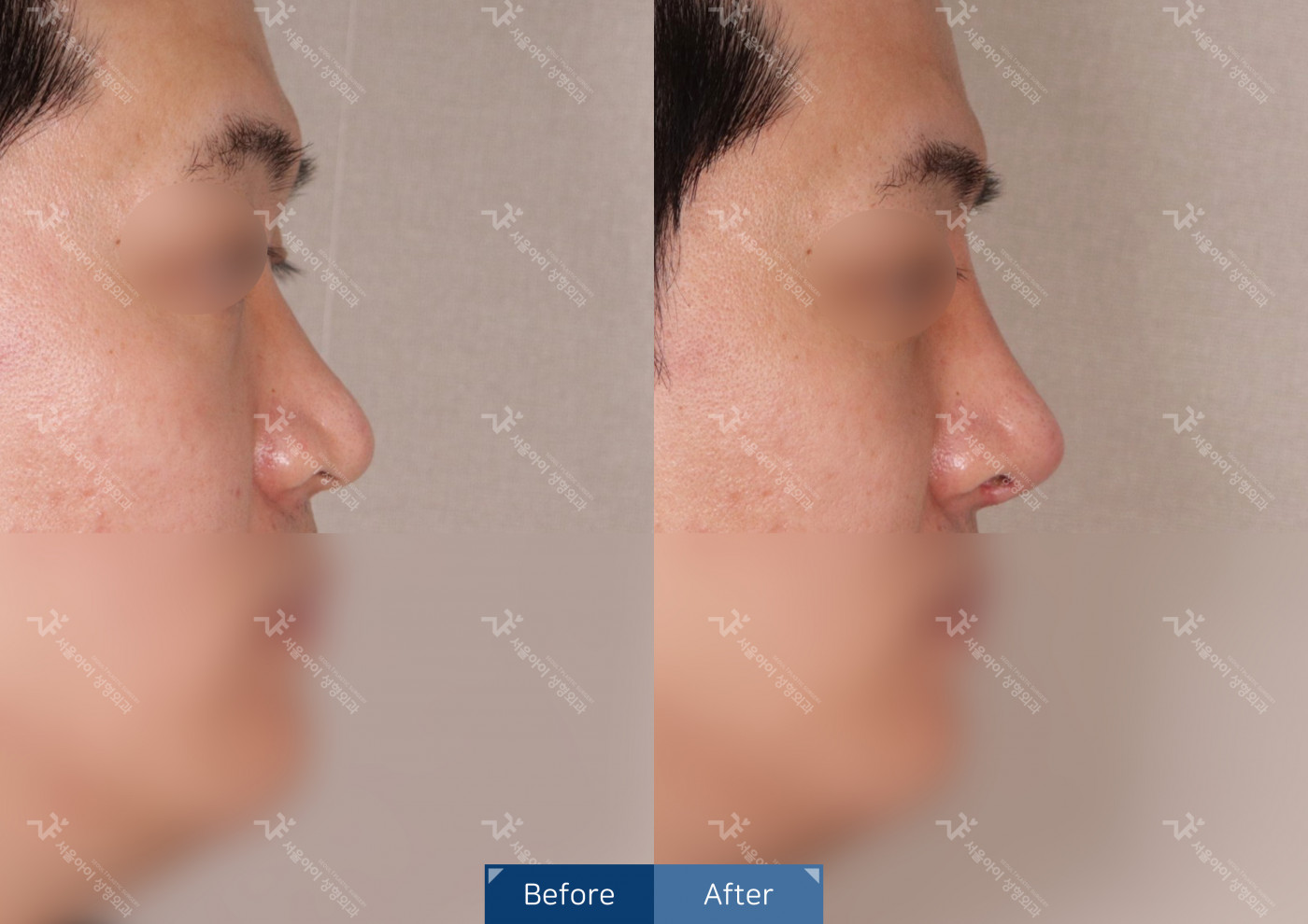 코성형[융비술&코끝조각술(비중격)+복코교정술+짧은코교정]