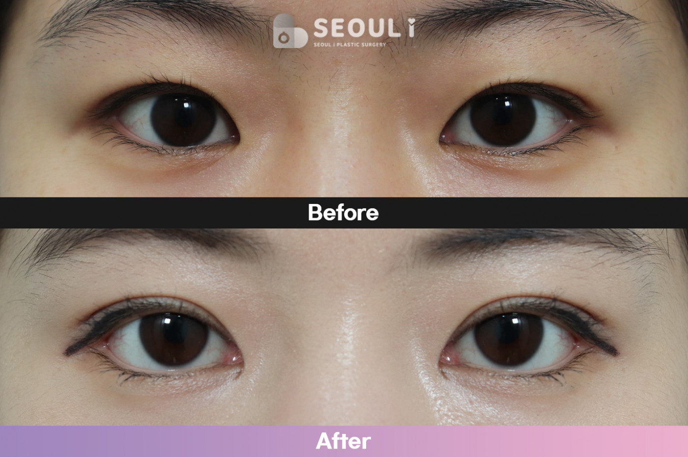 눈성형 [자연유착 쌍꺼풀 + 앞트임 + 뒷밑트임 + 눈매교정]