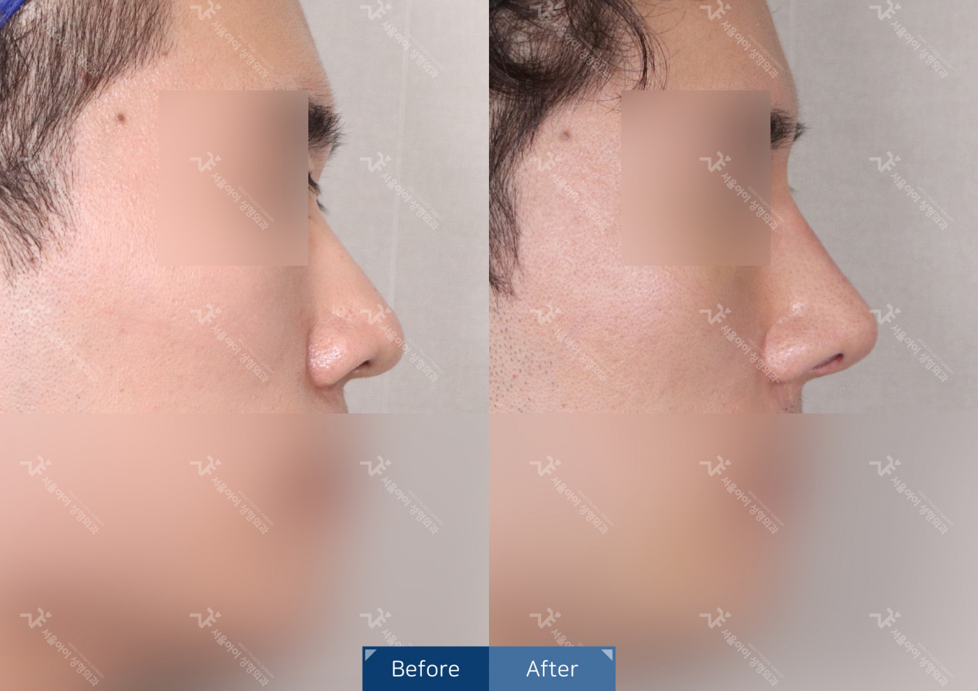 코성형 [코끝조각술(비중격)+복코교정+콧볼축소술+축비술]