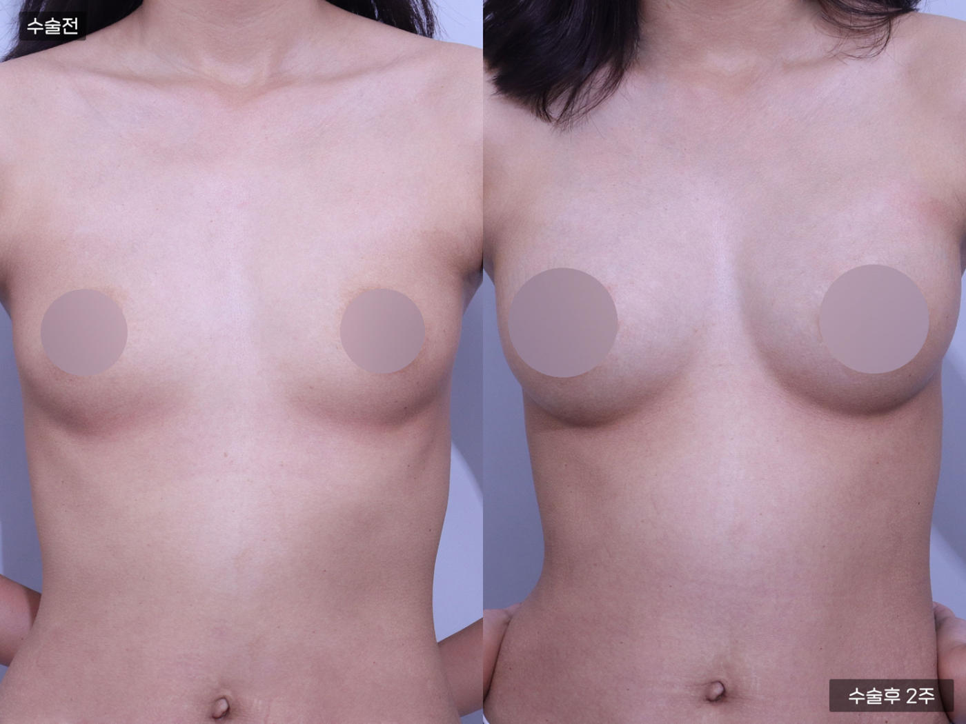 가슴성형 [가슴지방이식(300CC + 300CC)]
