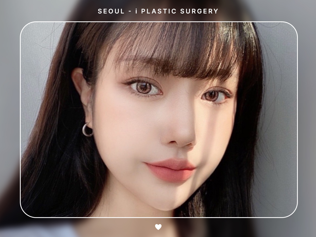 #코끝교정 #매부리코교정