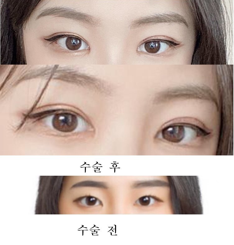 수술후기이미지