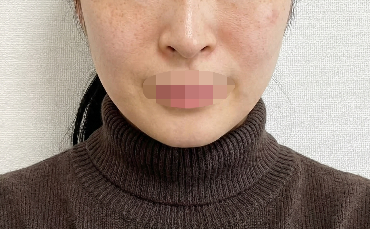 수술후기이미지