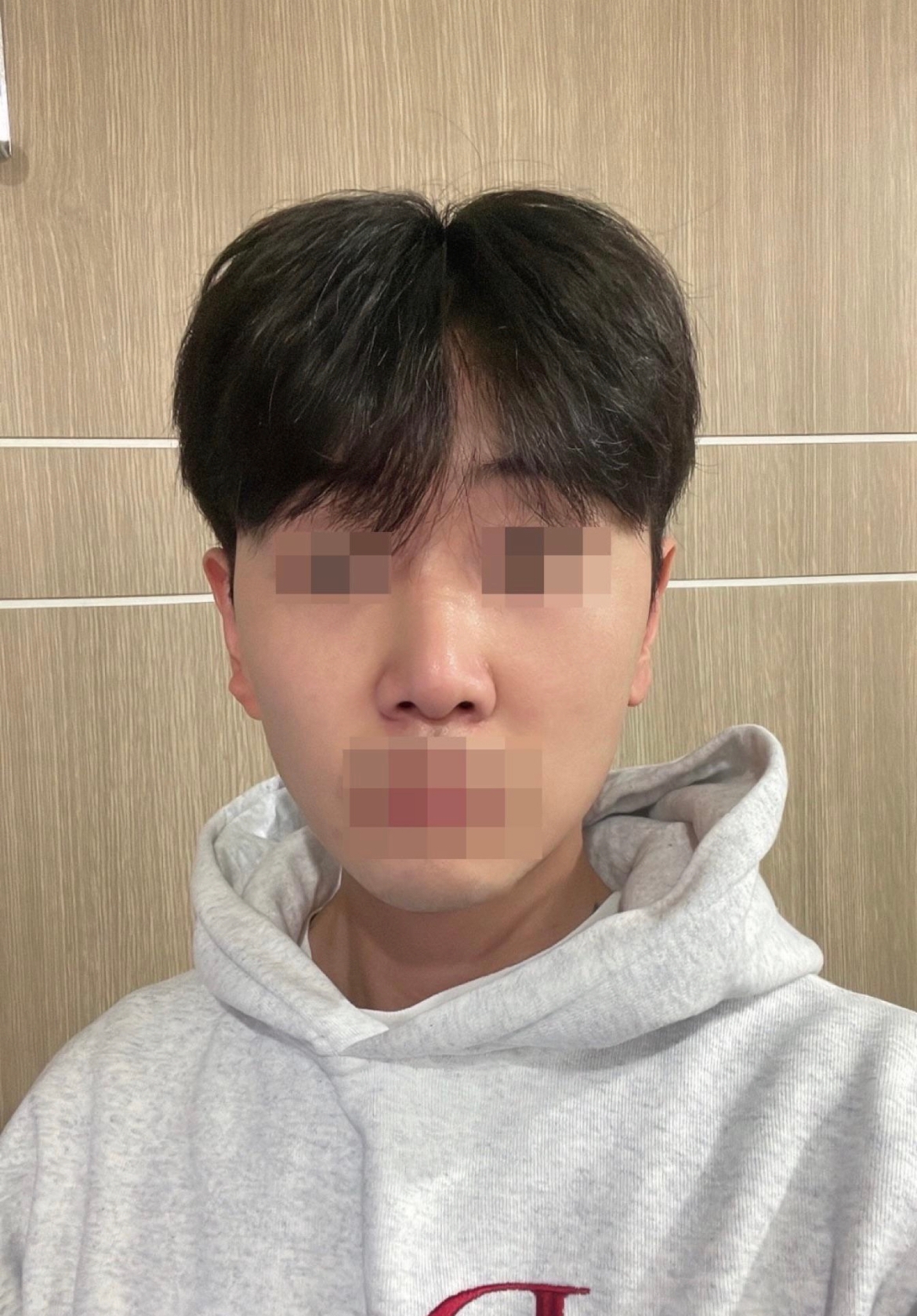 수술후기이미지