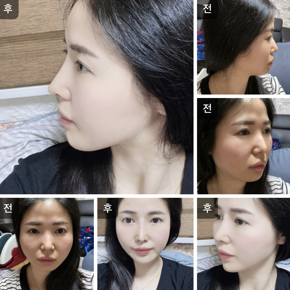 수술후기이미지