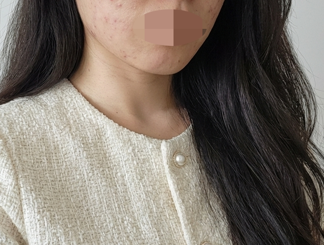 수술후기이미지