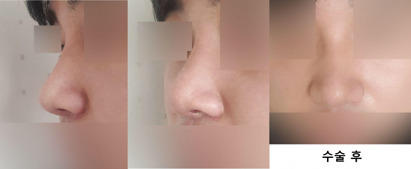 수술후기이미지