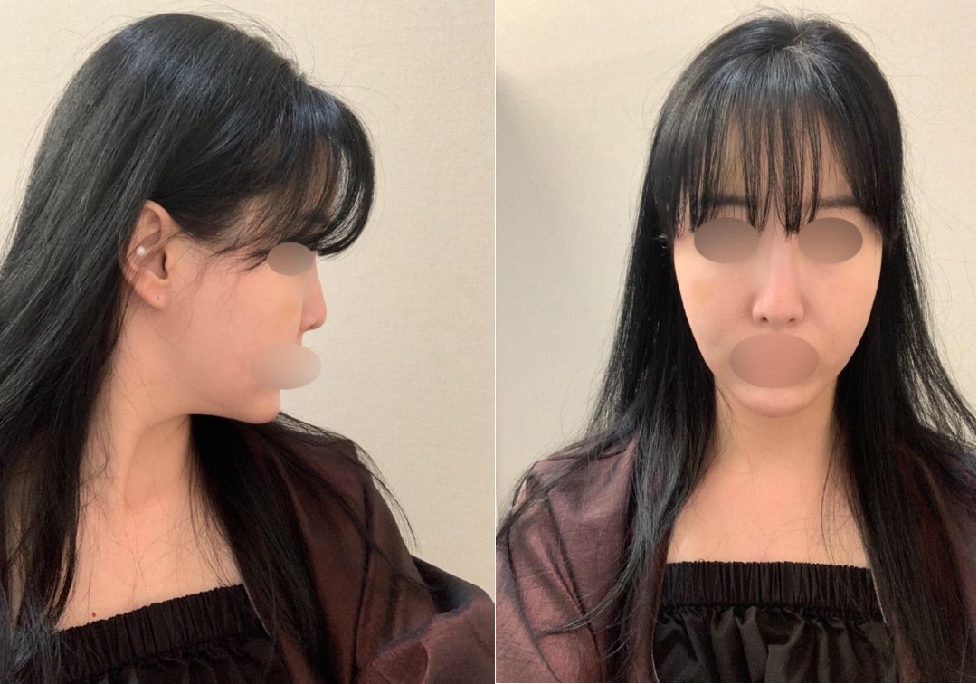 수술후기이미지