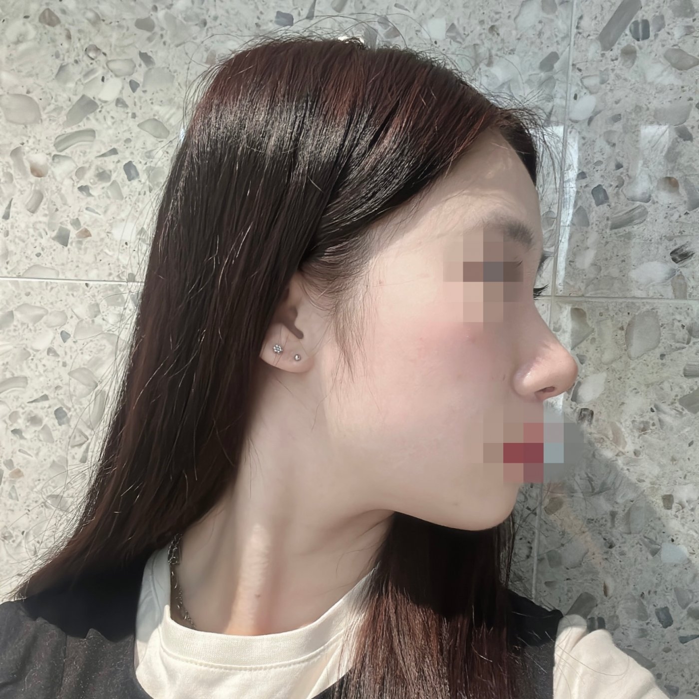 수술후기이미지