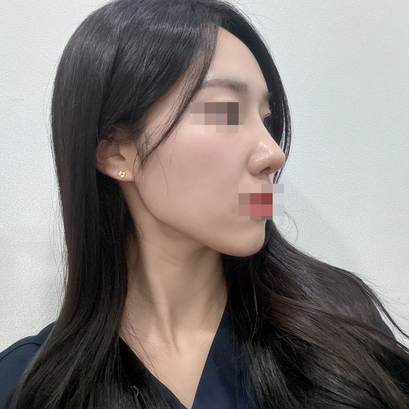 수술후기이미지