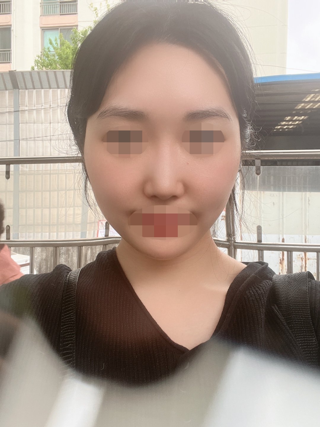 수술후기이미지