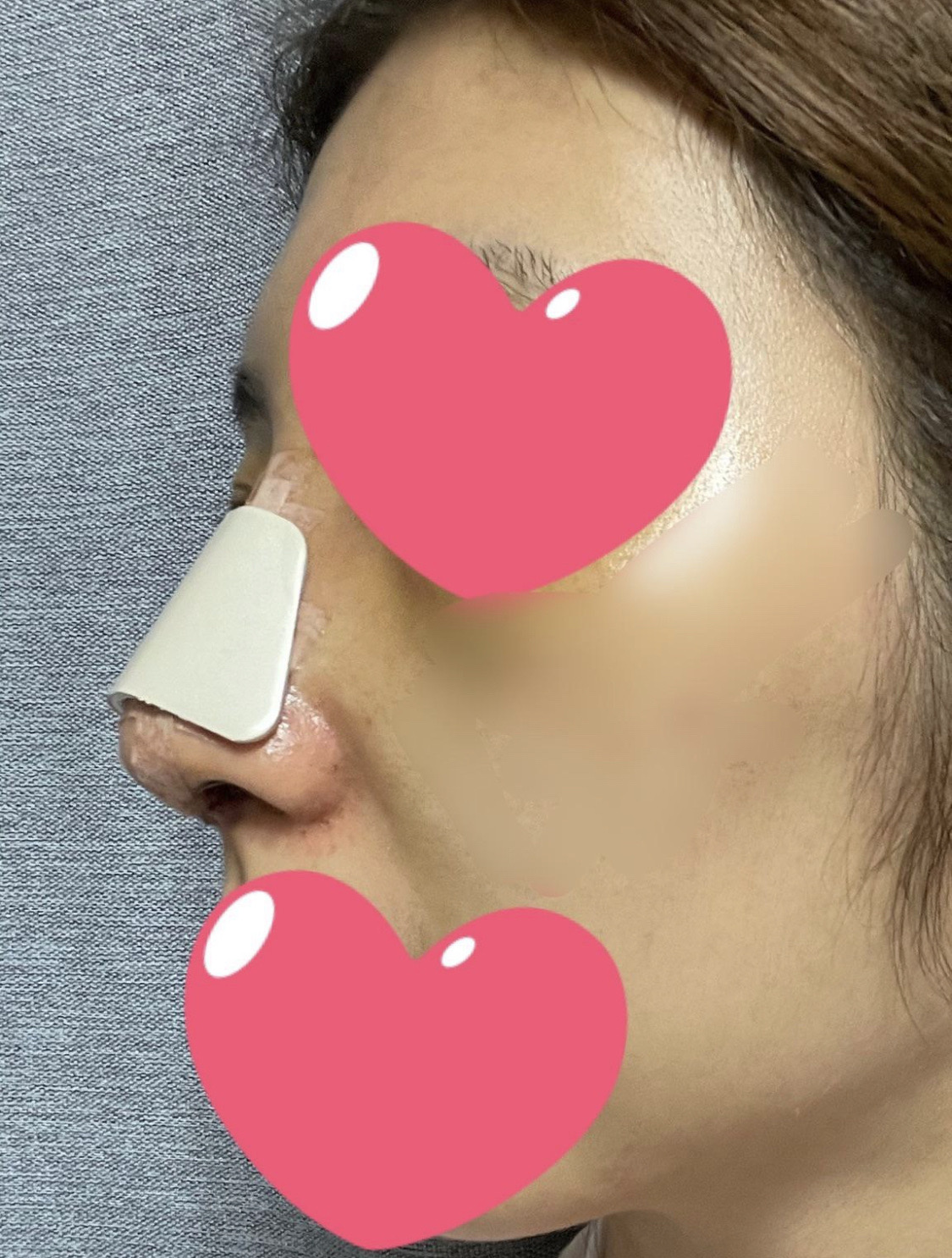 수술후기이미지