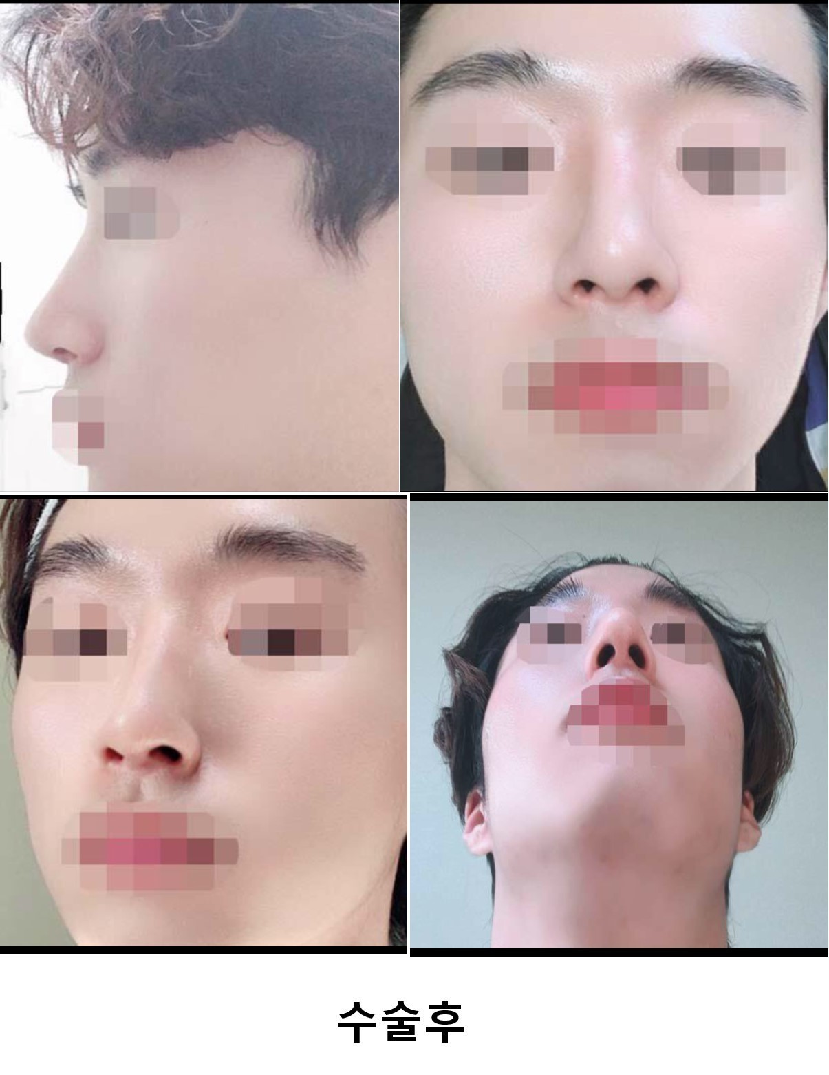 수술후기이미지