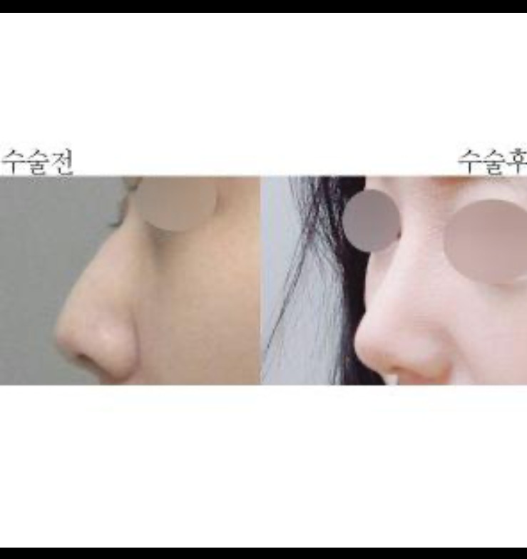 수술후기이미지