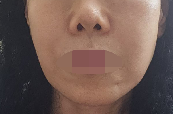 수술후기이미지