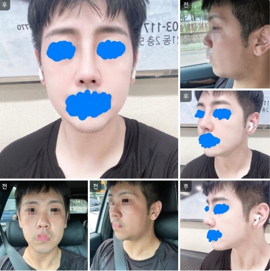 수술후기이미지