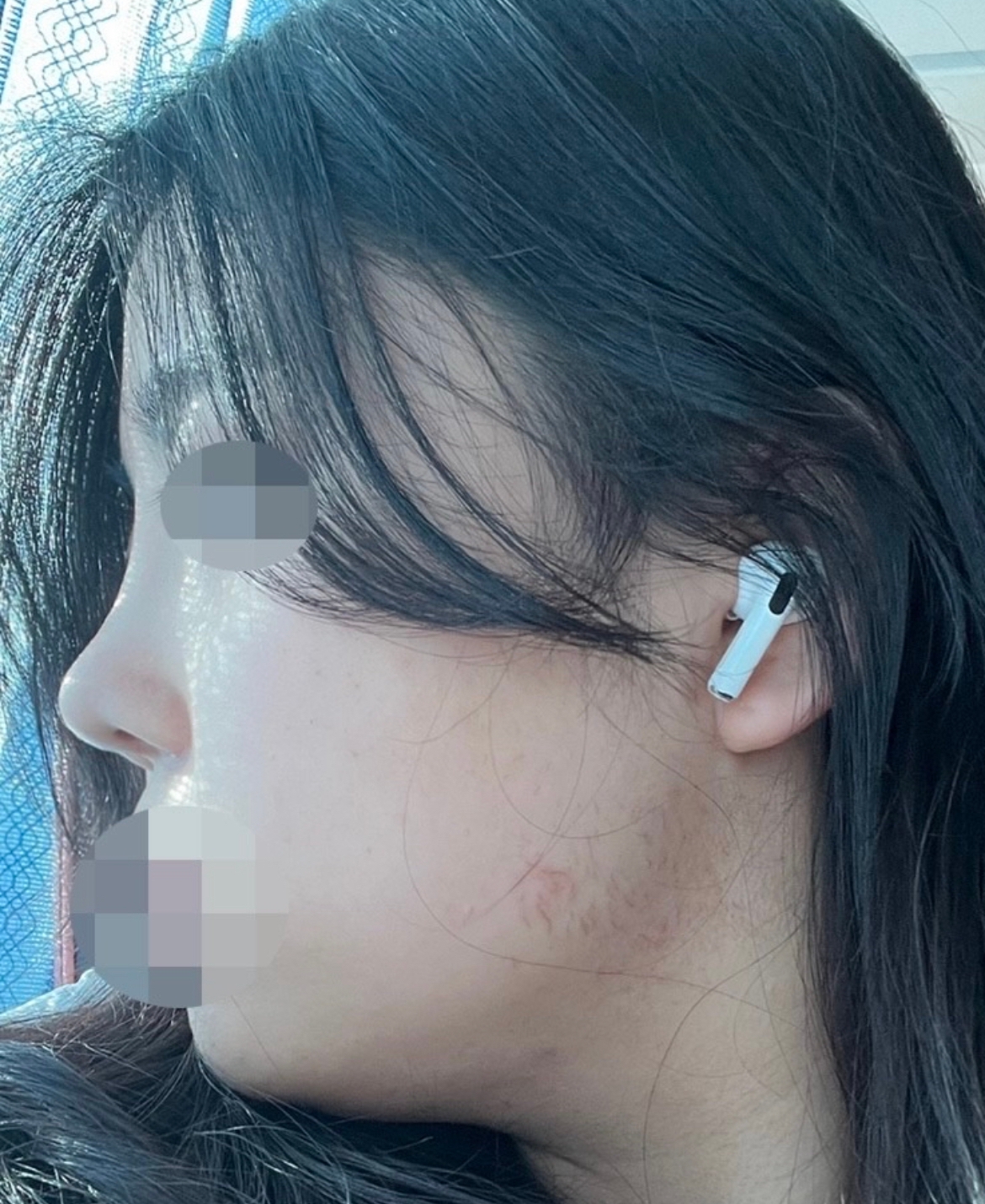 수술후기이미지