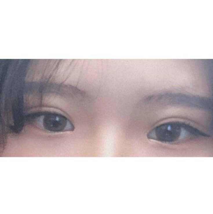 쌍수 후기입니당