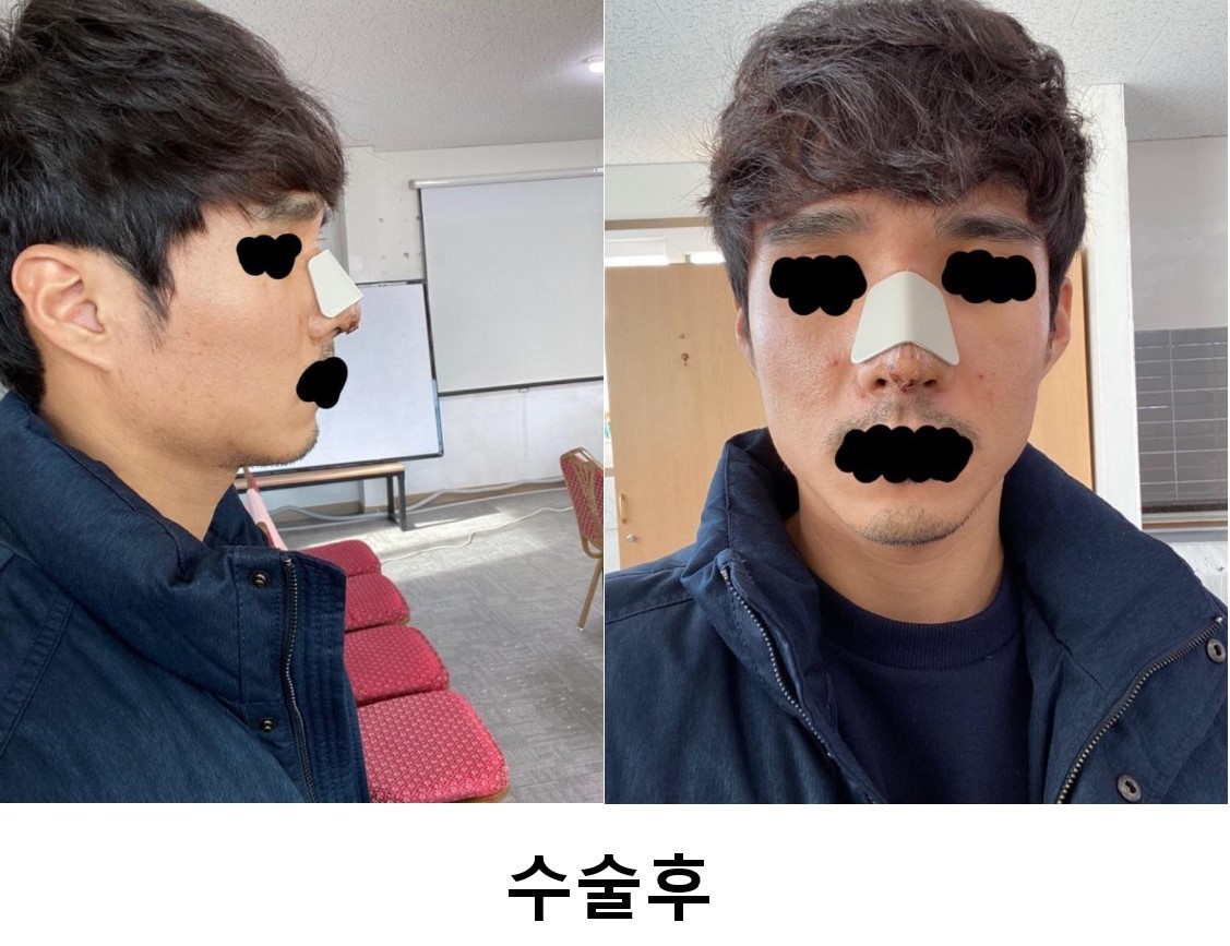 수술후기이미지